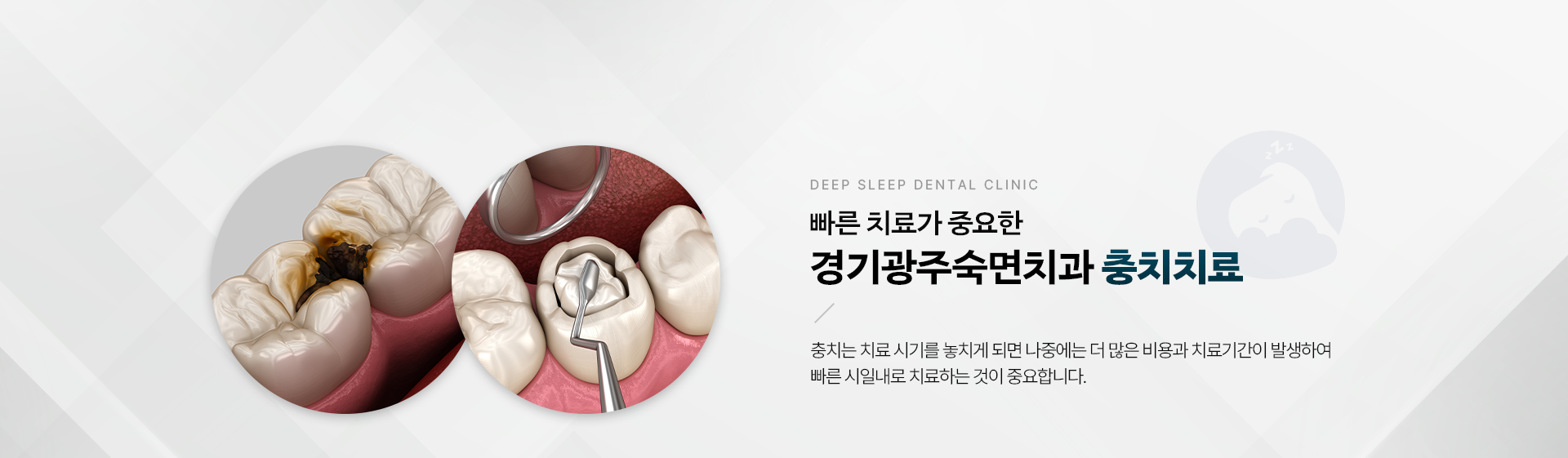 빠른 치료가 중요한 경기광주숙면치과 충치치료