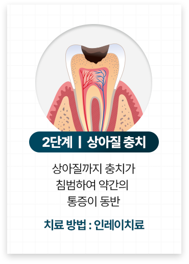 인레이